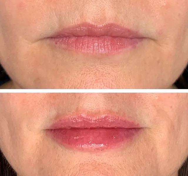 Before and After treatment results at Glo Med Spa in Austin, TX