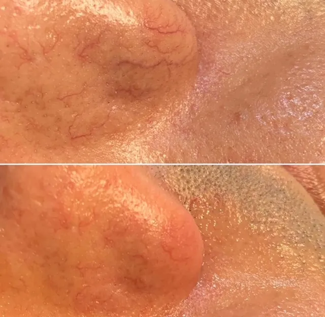 Before and After treatment results at Glo Med Spa in Austin, TX