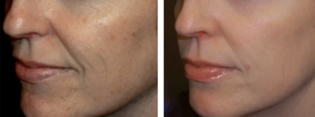 Before and After treatment results at Glo Med Spa in Austin, TX