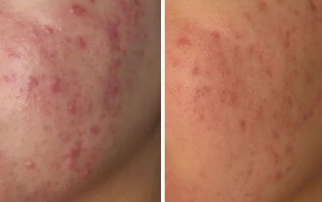 Before and After treatment results at Glo Med Spa in Austin, TX