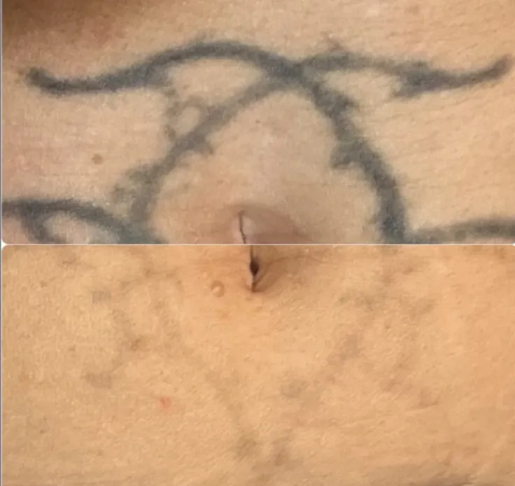 Before and After treatment results at Glo Med Spa in Austin, TX