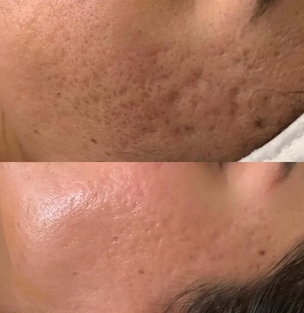 Before and After treatment results at Glo Med Spa in Austin, TX