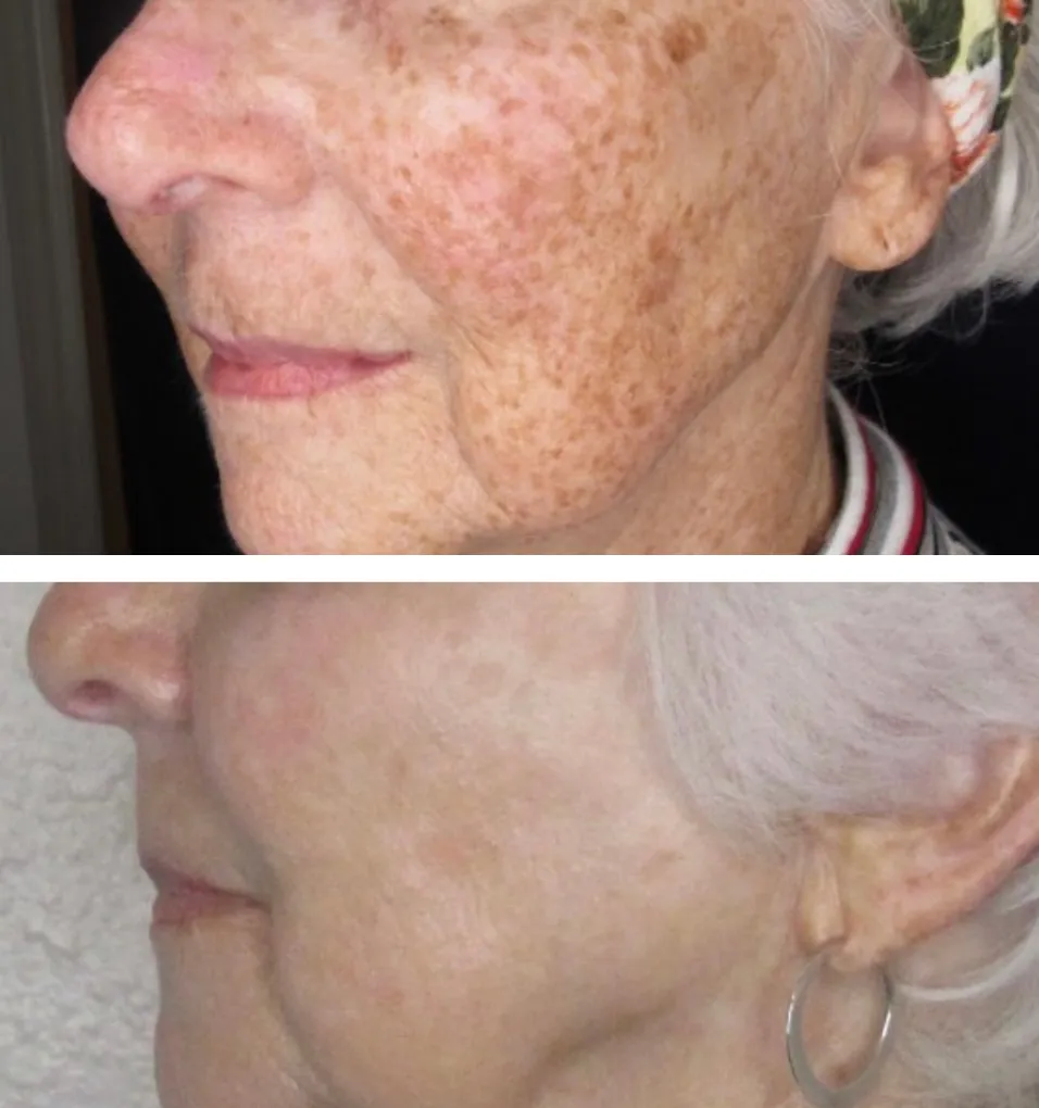 Before and After treatment results at Glo Med Spa in Austin, TX